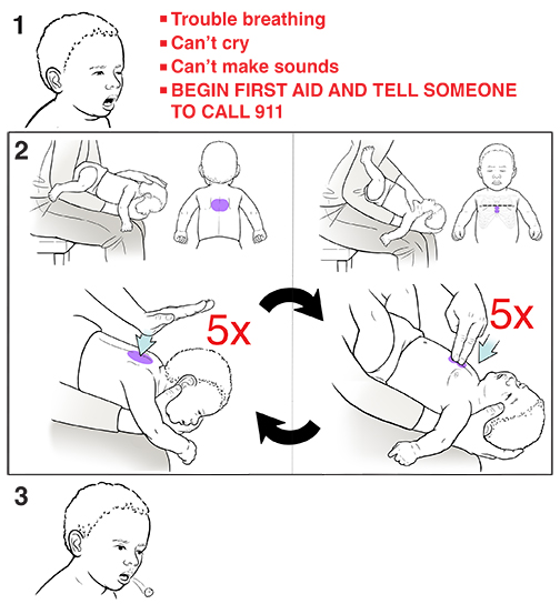Step-by-Step-Choking in an Infant- What to Do